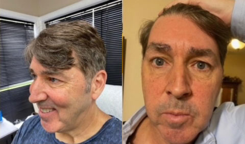 Botox Before & After Photo at La Lume Concierge Aesthetics in Rhinebeck, and Manhattan