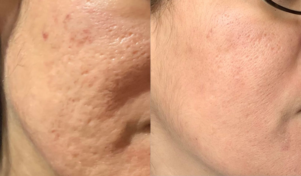 Microneedling Before & After Photo at La Lume Concierge Aesthetics in Rhinebeck, and Manhattan
